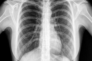  TB & Chest Department
